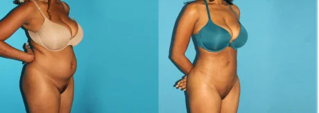 Brazilian Butt Lift case #4675