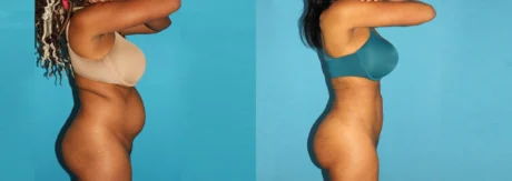 Brazilian Butt Lift case #4675