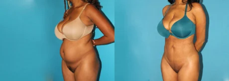 Brazilian Butt Lift case #4675