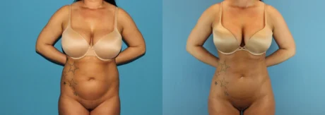 Brazilian Butt Lift case #4820