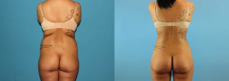 Brazilian Butt Lift case #4820