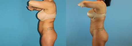 Brazilian Butt Lift case #4820