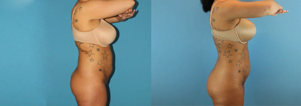 Brazilian Butt Lift case #4820