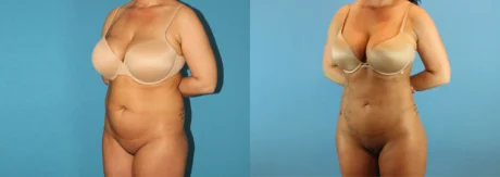 Brazilian Butt Lift case #4820