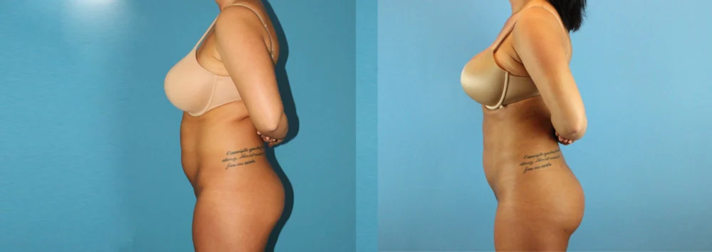 Brazilian Butt Lift case #4820