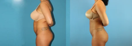 Brazilian Butt Lift case #4820