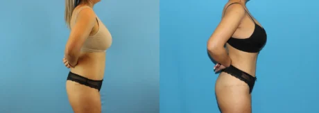 Brazilian Butt Lift case #4881