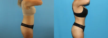 Brazilian Butt Lift case #4881