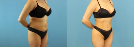 Brazilian Butt Lift case #4903