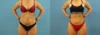 Brazilian Butt Lift case #4963 slider thumbnail