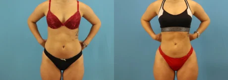 Brazilian Butt Lift case #4963