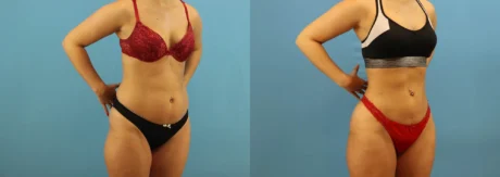 Brazilian Butt Lift case #4963