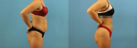 Brazilian Butt Lift case #4963