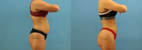 Brazilian Butt Lift case #4963