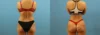 Brazilian Butt Lift case #4963 slider thumbnail