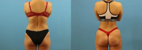 Brazilian Butt Lift case #4963