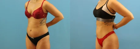 Brazilian Butt Lift case #4963