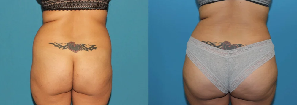 Brazilian Butt Lift case #4965