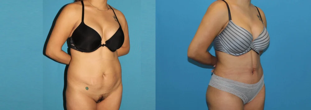 Brazilian Butt Lift case #4965