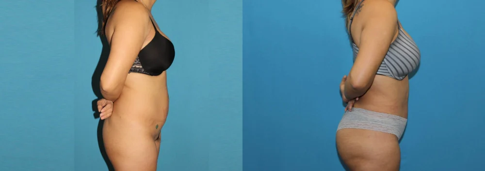 Brazilian Butt Lift case #4965