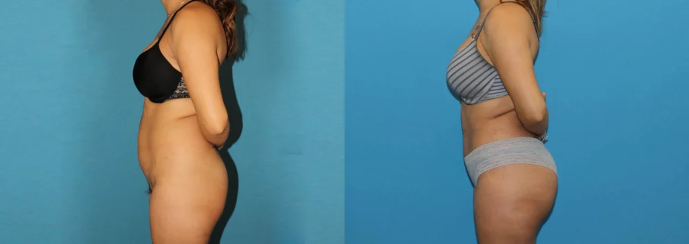 Brazilian Butt Lift case #4965