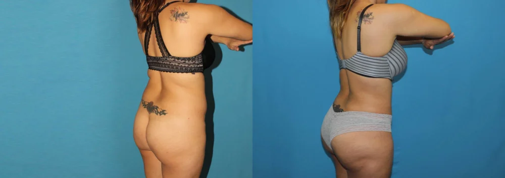 Brazilian Butt Lift case #4965