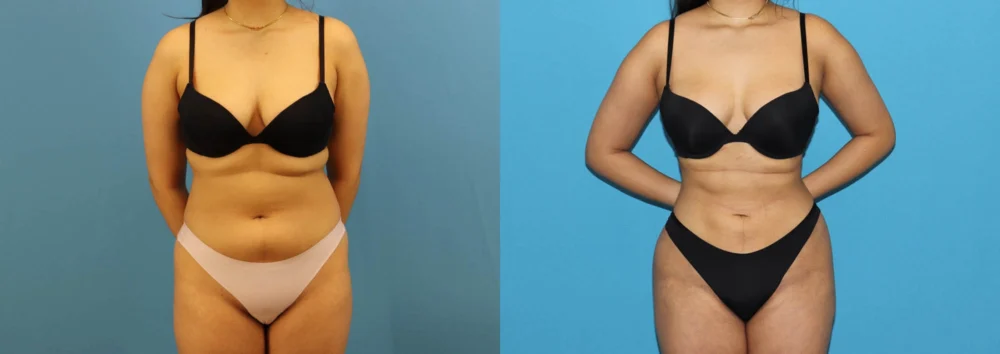 Brazilian Butt Lift case #4966