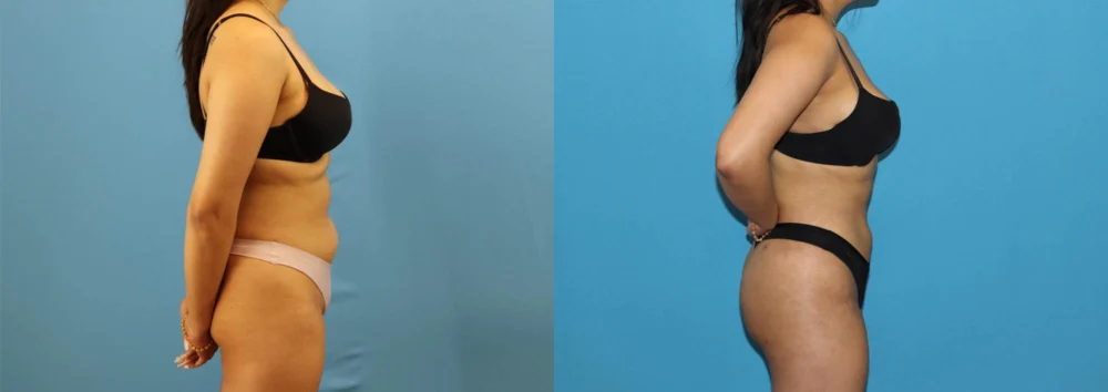 Brazilian Butt Lift case #4966