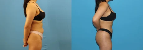 Brazilian Butt Lift case #4966