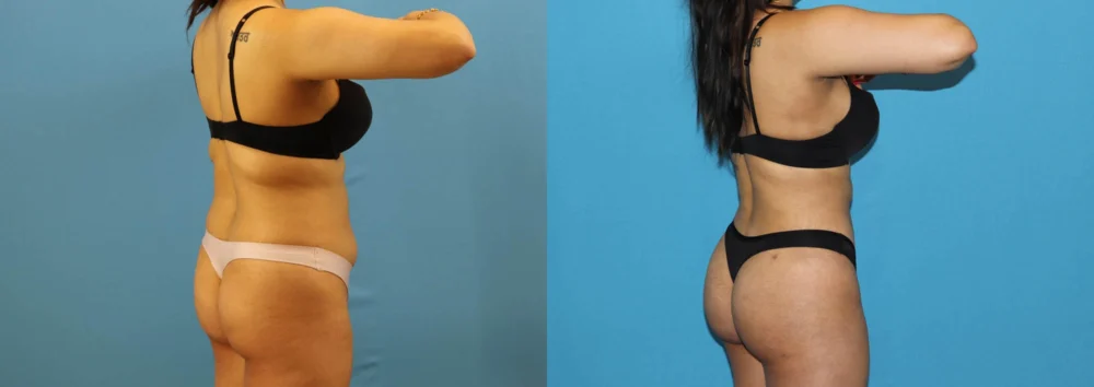 Brazilian Butt Lift case #4966