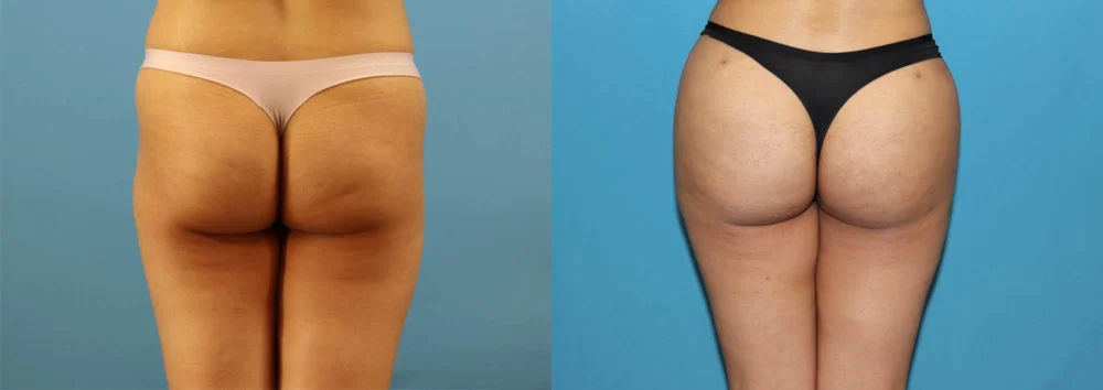 Brazilian Butt Lift case #4966