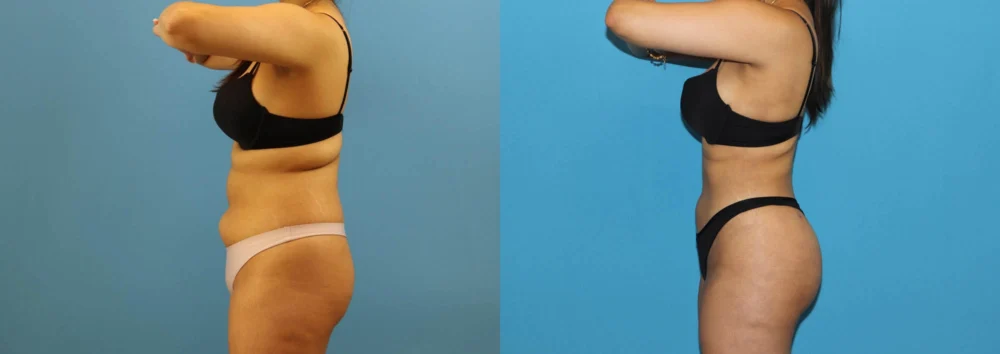 Brazilian Butt Lift case #4966