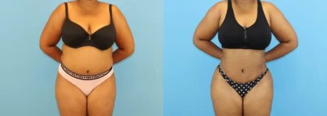 Brazilian Butt Lift case #5116