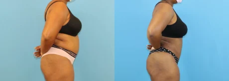 Brazilian Butt Lift case #5116