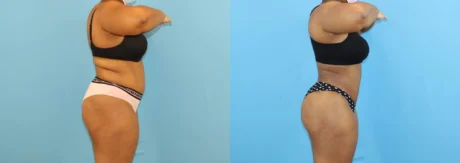 Brazilian Butt Lift case #5116