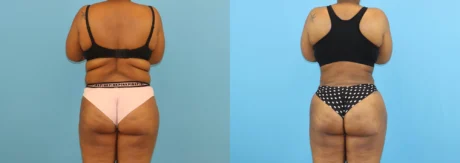 Brazilian Butt Lift case #5116