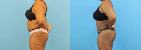 Brazilian Butt Lift case #5116