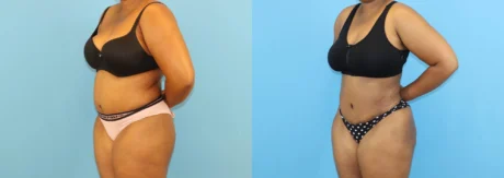 Brazilian Butt Lift case #5116