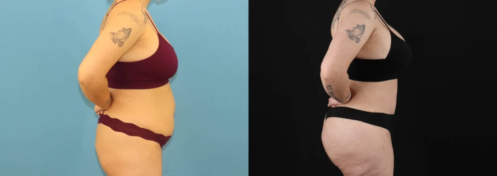 Brazilian Butt Lift case #5119