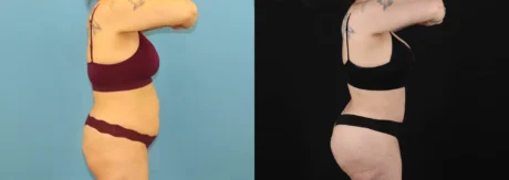 Brazilian Butt Lift case #5119