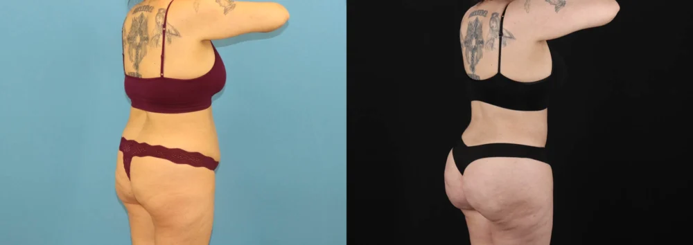 Brazilian Butt Lift case #5119