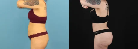 Brazilian Butt Lift case #5119