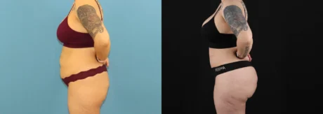 Brazilian Butt Lift case #5119