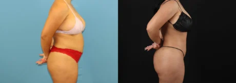 Brazilian Butt Lift case #5168