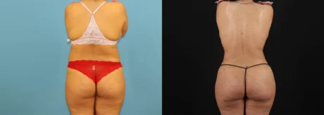 Brazilian Butt Lift case #5168