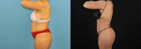 Brazilian Butt Lift case #5168