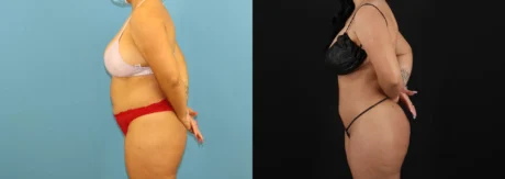 Brazilian Butt Lift case #5168