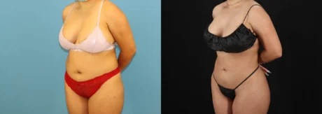 Brazilian Butt Lift case #5168