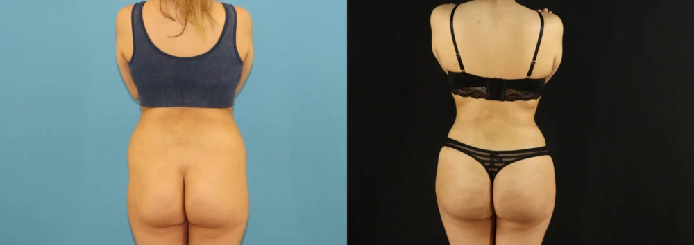 Brazilian Butt Lift case #5169