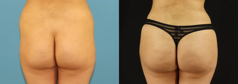 Brazilian Butt Lift case #5169